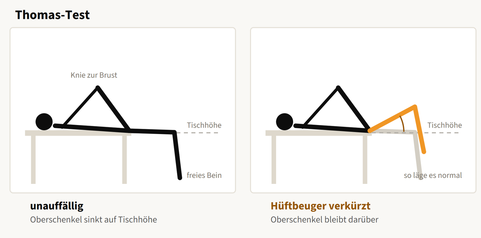 Thomas-Test in der Seitenansicht. Links sinkt der Oberschenkel des freien Beins auf Tischhöhe, rechts bleibt er darüber.