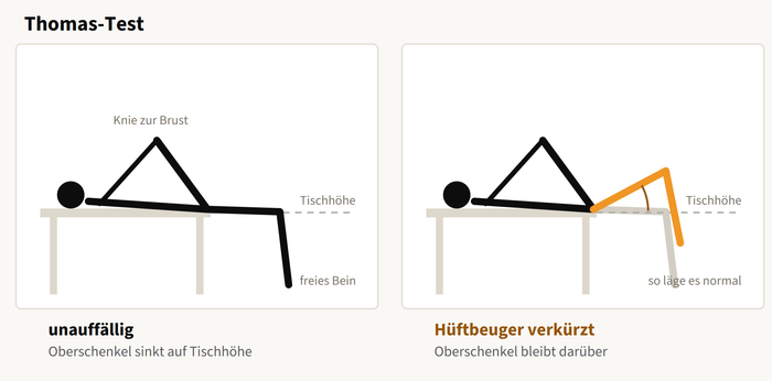 Thomas-Test in der Seitenansicht. Links sinkt der Oberschenkel des freien Beins auf Tischhöhe, rechts bleibt er darüber.